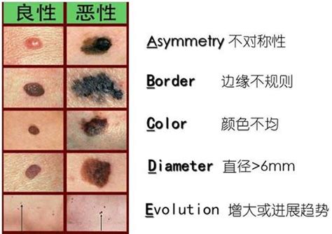 好痣壞痣怎麼分|痣如何去除？ 